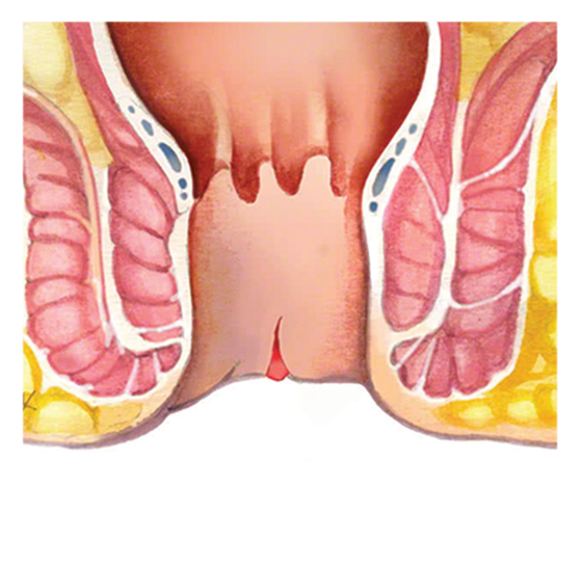 Fissure