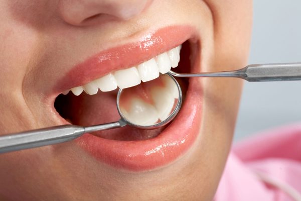 Fisher-Pointe-_-Blog-Dental-Filling-Procedure-Steps